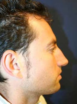 Ear Surgery-Dr. Kenrick Spence