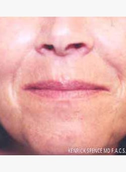 Fat Grafting Lips-Dr. Kenrick Spence