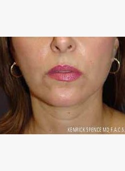 Mini Face lift-Dr. Kenrick Spence
