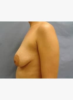 Breast Lift-Dr. Kenrick Spence
