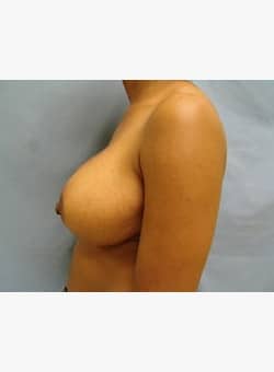 Breast Reduction-Dr. Kenrick Spence