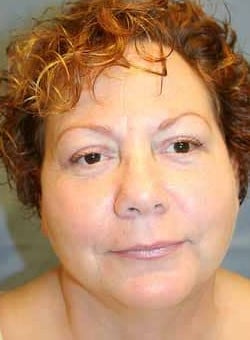 Brow Lift & Eyelid Surgery-Dr. Kenrick Spence