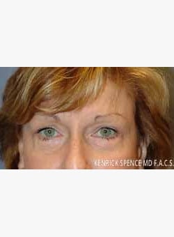 Brow Lift & Eyelid Surgery