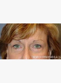 Brow Lift & Eyelid Surgery-Dr. Kenrick Spence