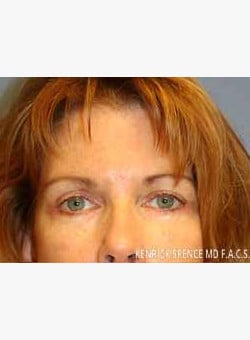 Brow Lift & Eyelid Surgery-Dr. Kenrick Spence