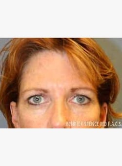 Brow Lift & Eyelid Surgery-Dr. Kenrick Spence