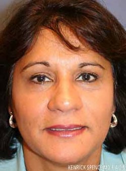 Brow Lift & Eyelid Surgery-Dr. Kenrick Spence