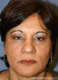 Brow Lift & Eyelid Surgery-Dr. Kenrick Spence