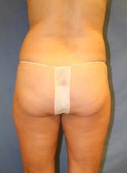 Liposuction Abdomen-Dr. Kenrick Spence