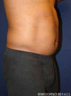 Liposuction Abdomen-Dr. Kenrick Spence