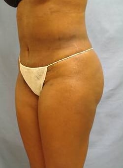Liposuction Abdomen