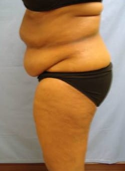 Liposuction Abdomen