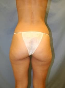 Liposuction Back-Dr. Kenrick Spence