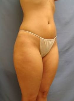 Liposuction Back