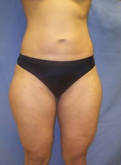 Liposuction Saddlebags and Thighs