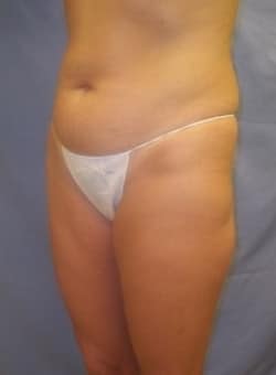 Liposuction Saddlebags and Thighs