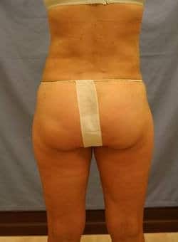 Liposuction Saddlebags and Thighs-Dr. Kenrick Spence