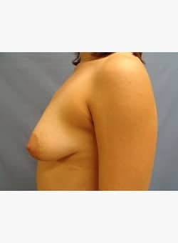 Breast Augmentation-Dr. Kenrick Spence