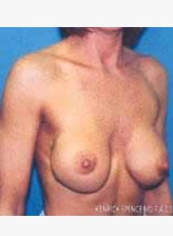 Breast Implant Revisions