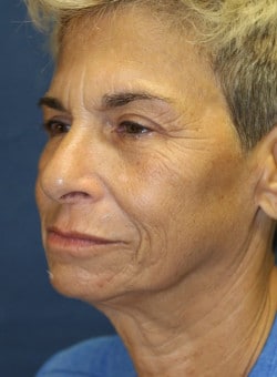 Facelift-Dr. Kenrick Spence