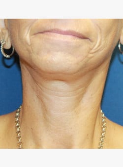 After Image