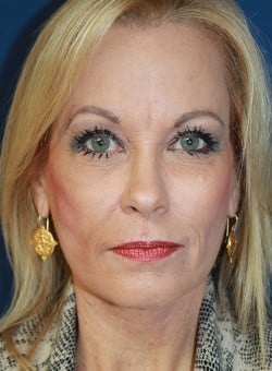 Facelift-Dr. Kenrick Spence