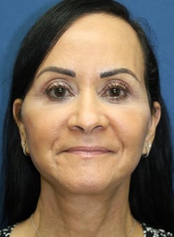 Facelift-Dr. Kenrick Spence