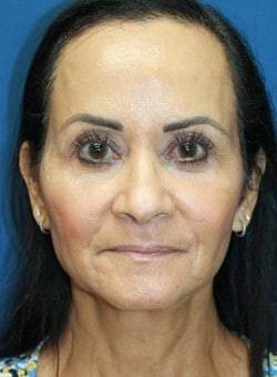 Facelift-Dr. Kenrick Spence