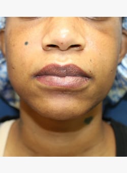 Cheiloplasty (Lip Reduction)-Dr. Kenrick Spence