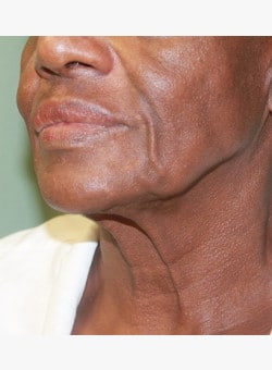 Lower Face lift-Dr. Kenrick Spence