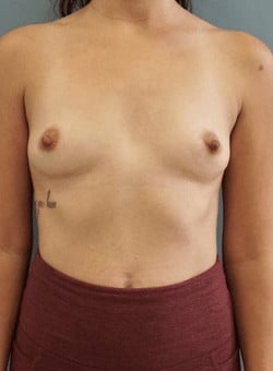 Breast Augmentation-Dr. Fernando Ovalle