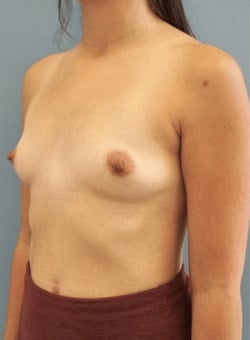 Breast Augmentation-Dr. Ovalle