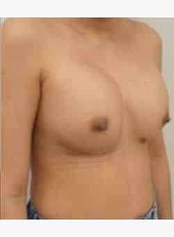 Breast Augmentation-Dr. Ovalle