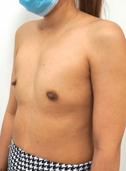Breast Augmentation-Dr. Fernando Ovalle