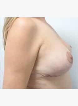 Breast Augmentation and Lift-Dr. Ovalle