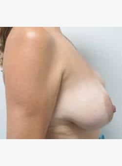 Breast Augmentation and Lift-Dr. Fernando Ovalle