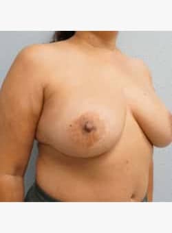 Breast Augmentation and Lift-Dr. Ovalle