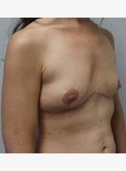 Breast Implant Removal-Dr. Ovalle