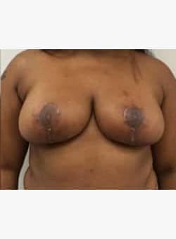 Breast Reduction and Lift-Dr. Fernando Ovalle