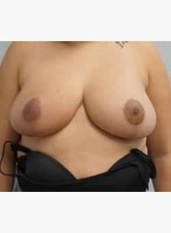 Breast Reduction and Lift-Dr. Ovalle