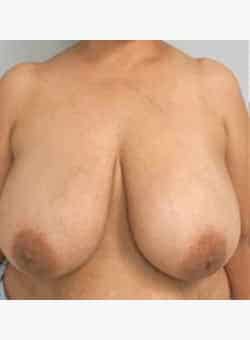 Breast Reduction and Lift-Dr. Fernando Ovalle