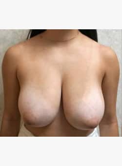 Breast Reduction and Lift-Dr. Ovalle