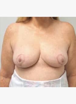 Breast Reduction and Lift-Dr. Fernando Ovalle
