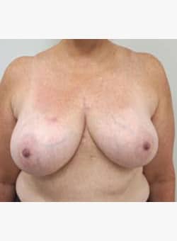 Breast Reduction and Lift-Dr. Fernando Ovalle