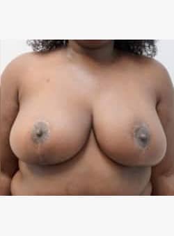 Breast Reduction and Lift-Dr. Fernando Ovalle
