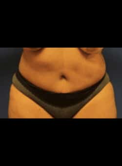 Abdominoplasty-Dr. Ovalle