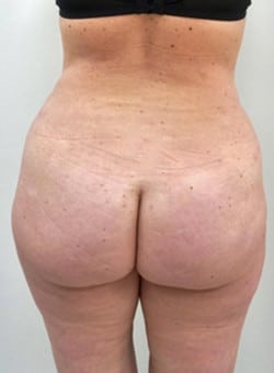 Brazilian Butt Lift with Liposuction-Dr. Fernando Ovalle