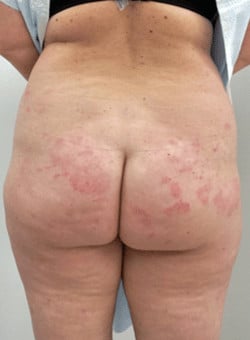 Brazilian Butt Lift with Liposuction-Dr. Fernando Ovalle