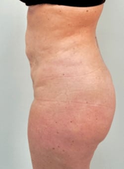 Brazilian Butt Lift with Liposuction-Dr. Ovalle