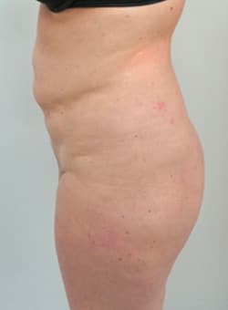Brazilian Butt Lift with Liposuction-Dr. Fernando Ovalle